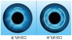 全飞秒激光手术要具备什么条件